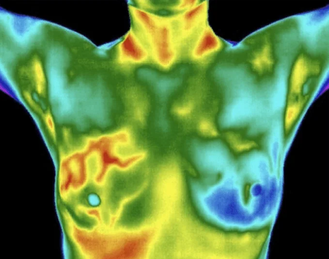 Example breast thermography image showing a color map of surface-temperature patterns