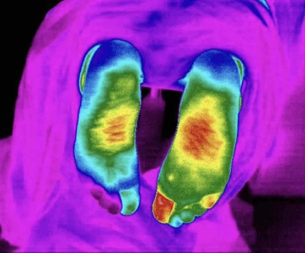Example thermography image of the feet showing surface-temperature patterns