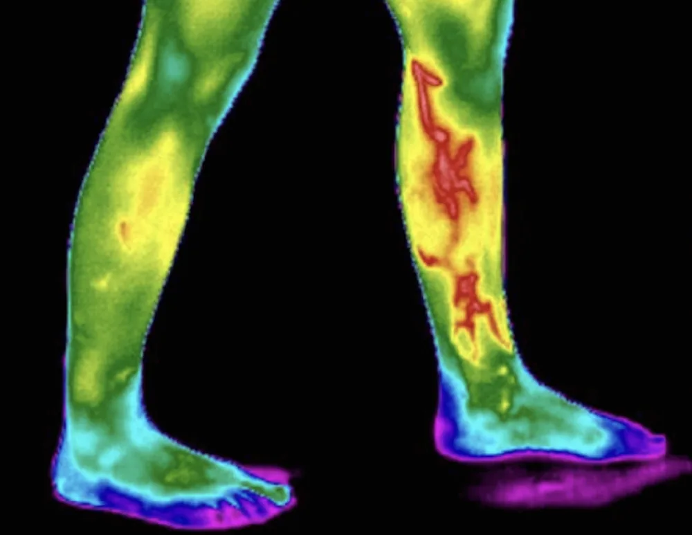 Example thermography image of the lower legs showing surface-temperature patterns