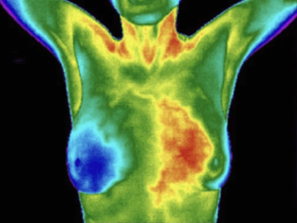 Example breast thermography image captured from another standardized angle